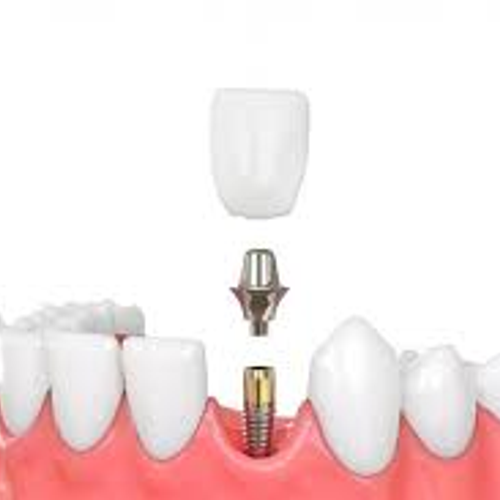 IMPLANT CROWN