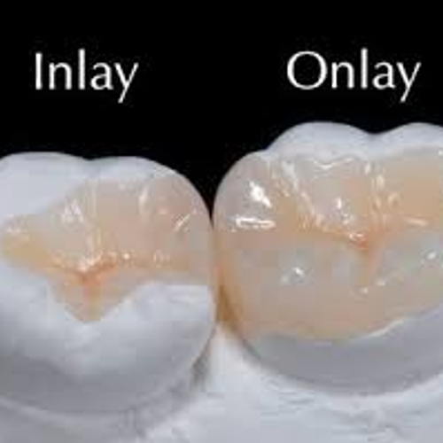 INLAY, ONLAY