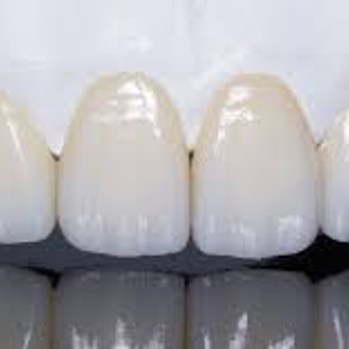 ALL CERAMIC CAD CAM CROWN